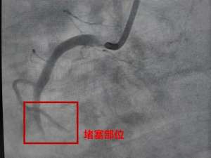 突发心梗趋于年轻化 急救指南一定要看→