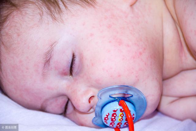宝宝湿疹反复发作，瘙痒难耐，皮肤科医师：妈妈给孩子保湿很重要
